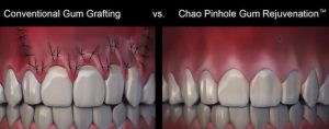 This picture shows the suturing that occurs with traditional gum grafting and the simple tiny hole perferation done with the pinhole surgical technique.
